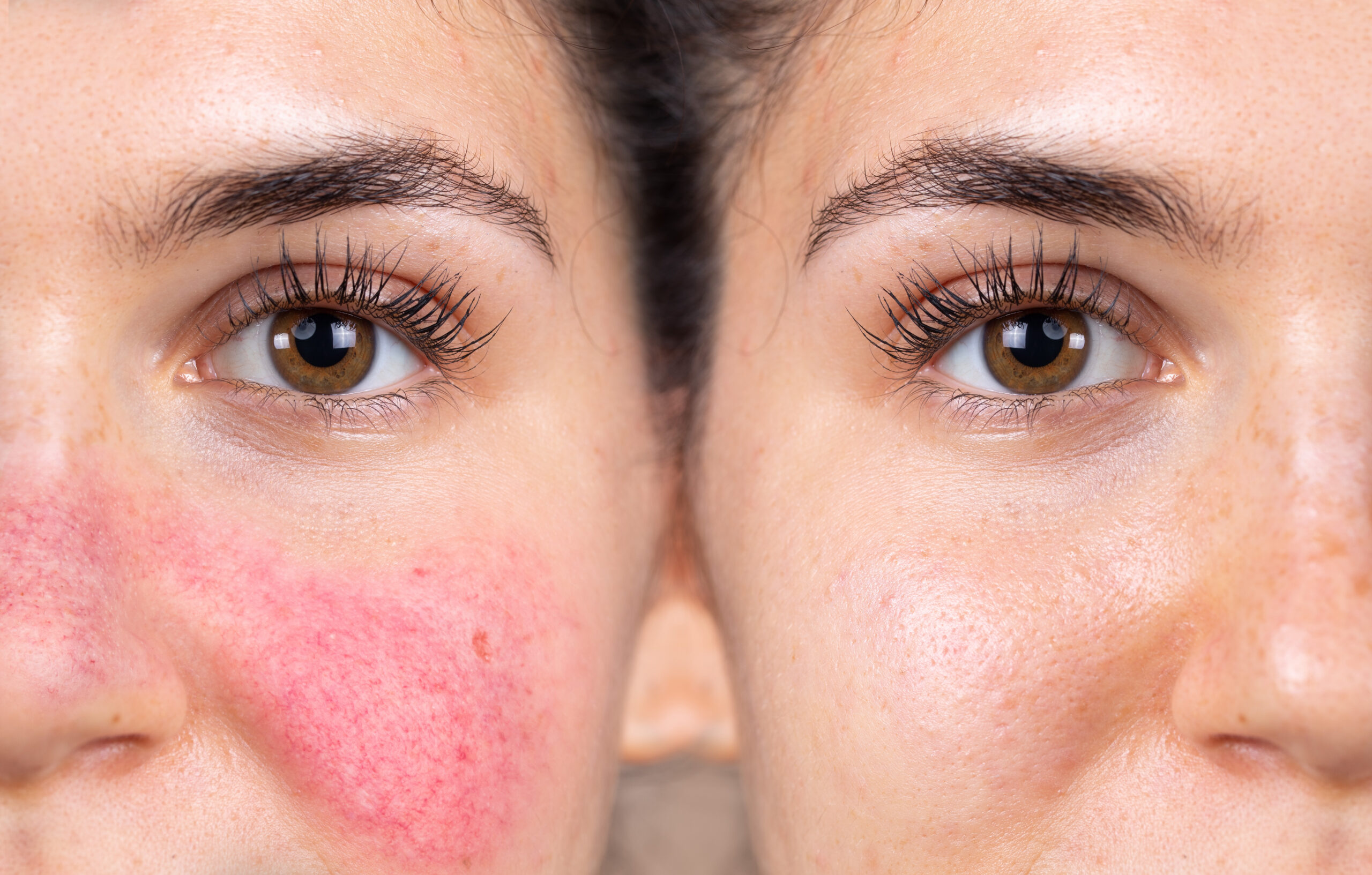 treating rosacea