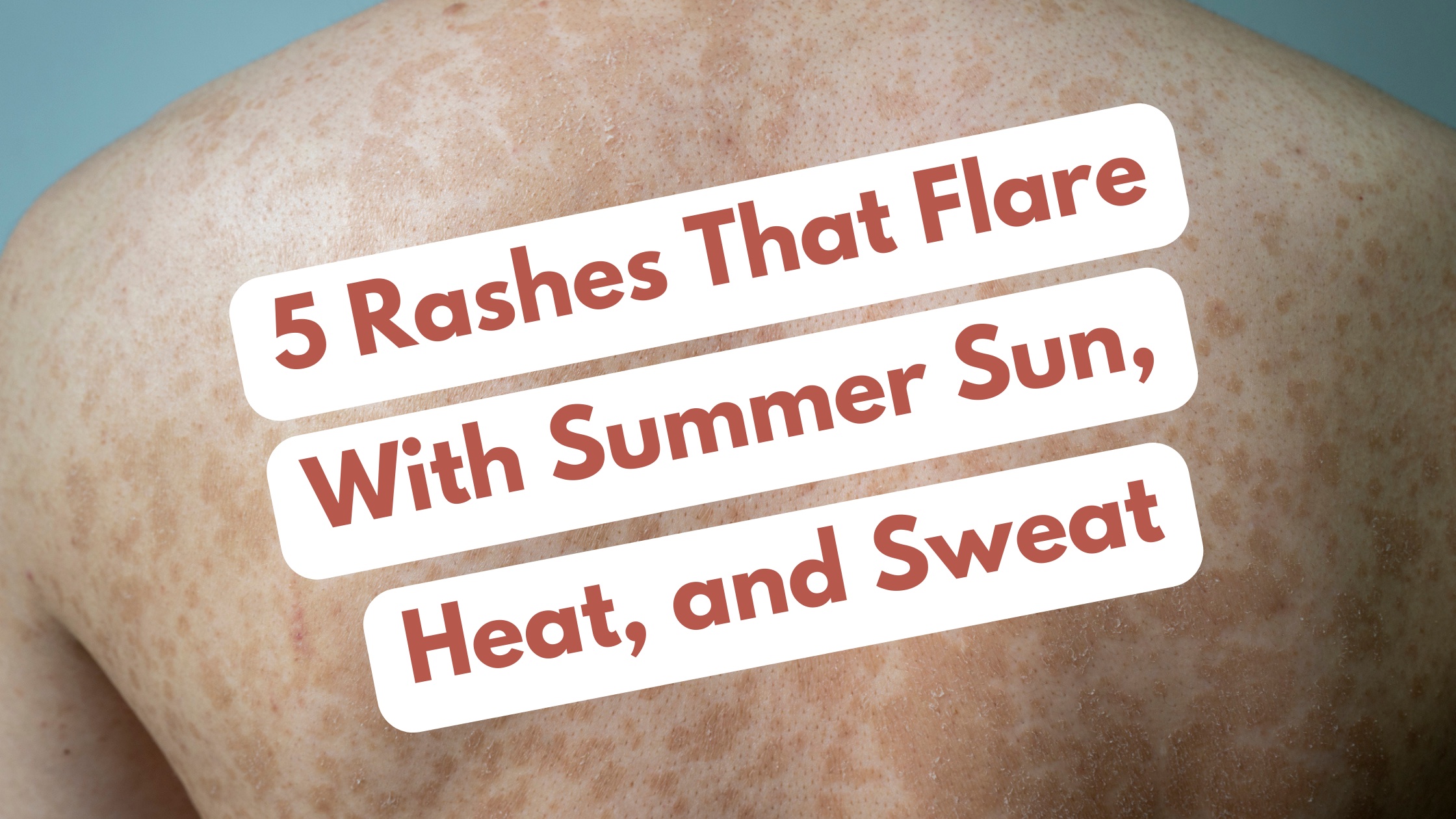 rashes that flare with summer