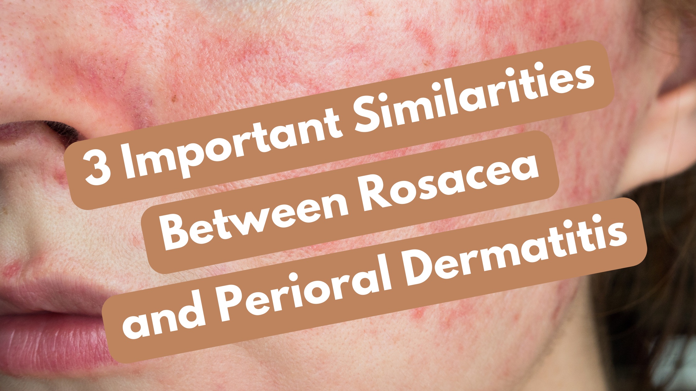 rosacea and perioral dermatitis